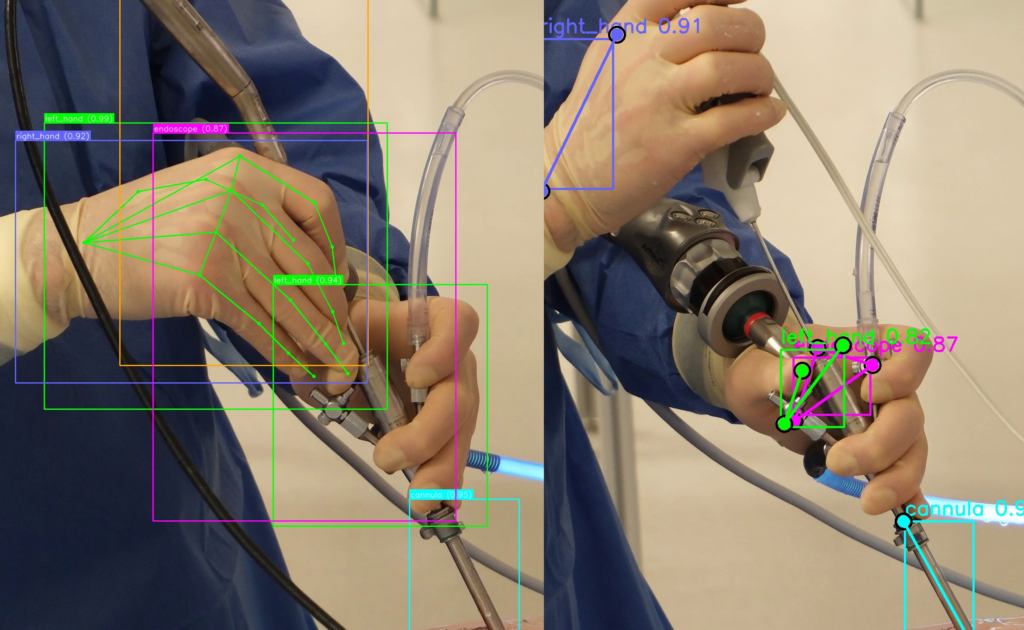 computer vision annotation and endoscopic spine surgery